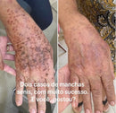 Facial Mask Skin Care - Remove manchas de Idade, Sol e Melasma! Para mãos e Rosto! FRETE GRÁTIS - Remove manchas de Idade, Sol e Melasma! Para mãos e Rosto! FRETE GRÁTIS