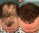 Hair Cover Pró - Preenchimento Capilar em 1 Minuto! FRETE GRÁTIS