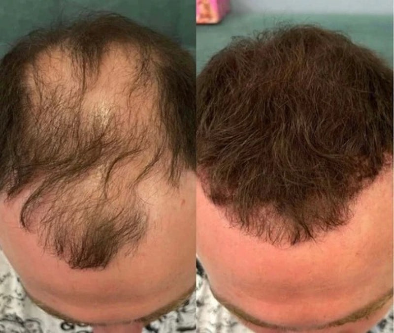 Hair Cover Pró - Preenchimento Capilar em 1 Minuto! FRETE GRÁTIS
