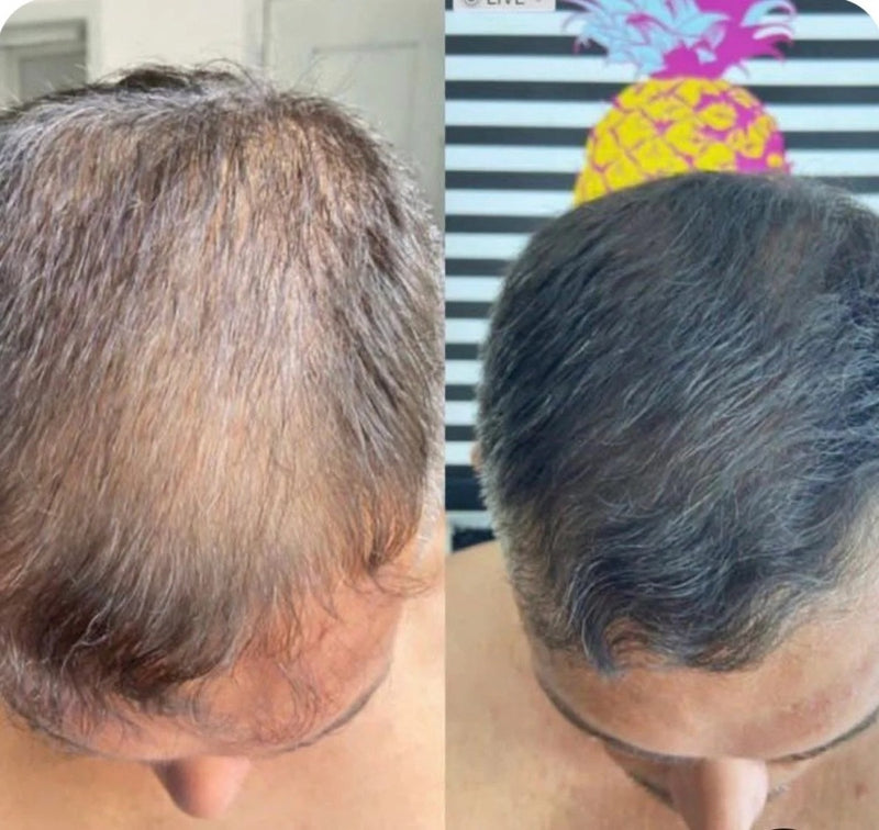 Hair Cover Pró - Preenchimento Capilar em 1 Minuto! FRETE GRÁTIS