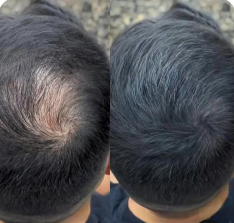Hair Cover Pró - Preenchimento Capilar em 1 Minuto! FRETE GRÁTIS