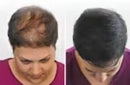 Hair Cover Pró - Preenchimento Capilar em 1 Minuto! FRETE GRÁTIS