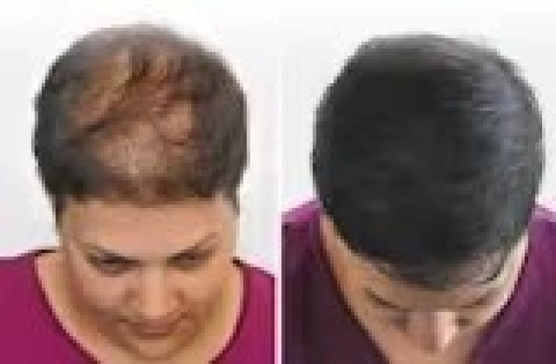 Hair Cover Pró - Preenchimento Capilar em 1 Minuto! FRETE GRÁTIS